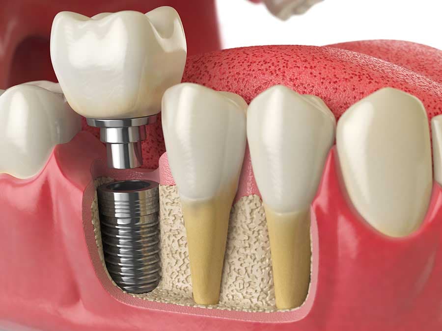 Cover Image for 🦷 Implants dentaires : le guide complet